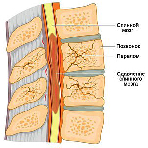 Sdavlenie spinnogo mozga