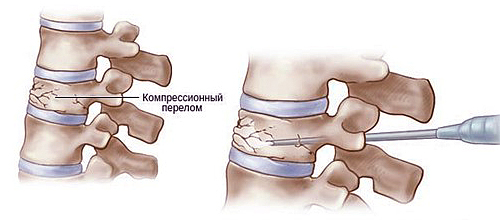 Vertebroplastika